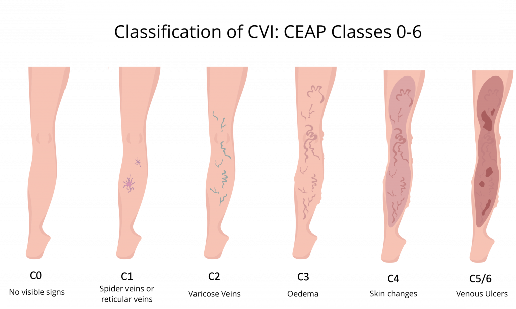 Venous System and CVI - Vascular Academy | powered by SOT